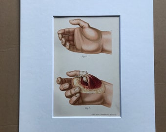 1902 Dislocation of the Thumb Original Antique Anatomical Print - Medical Decor - Anatomy - Mounted and Matted - Available Framed