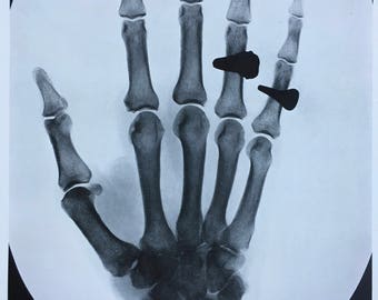 1935 Original Vintage Print - Available Framed - Radiology - Rheumatic Arthritis - Medical Decor - X Ray - Bones - Gift Idea