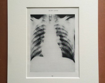 1941 Chest & Lung X-Ray Original Vintage Print - Mounted and Matted - Silicosis - Radiology - Medical Decor - Science - Available Framed