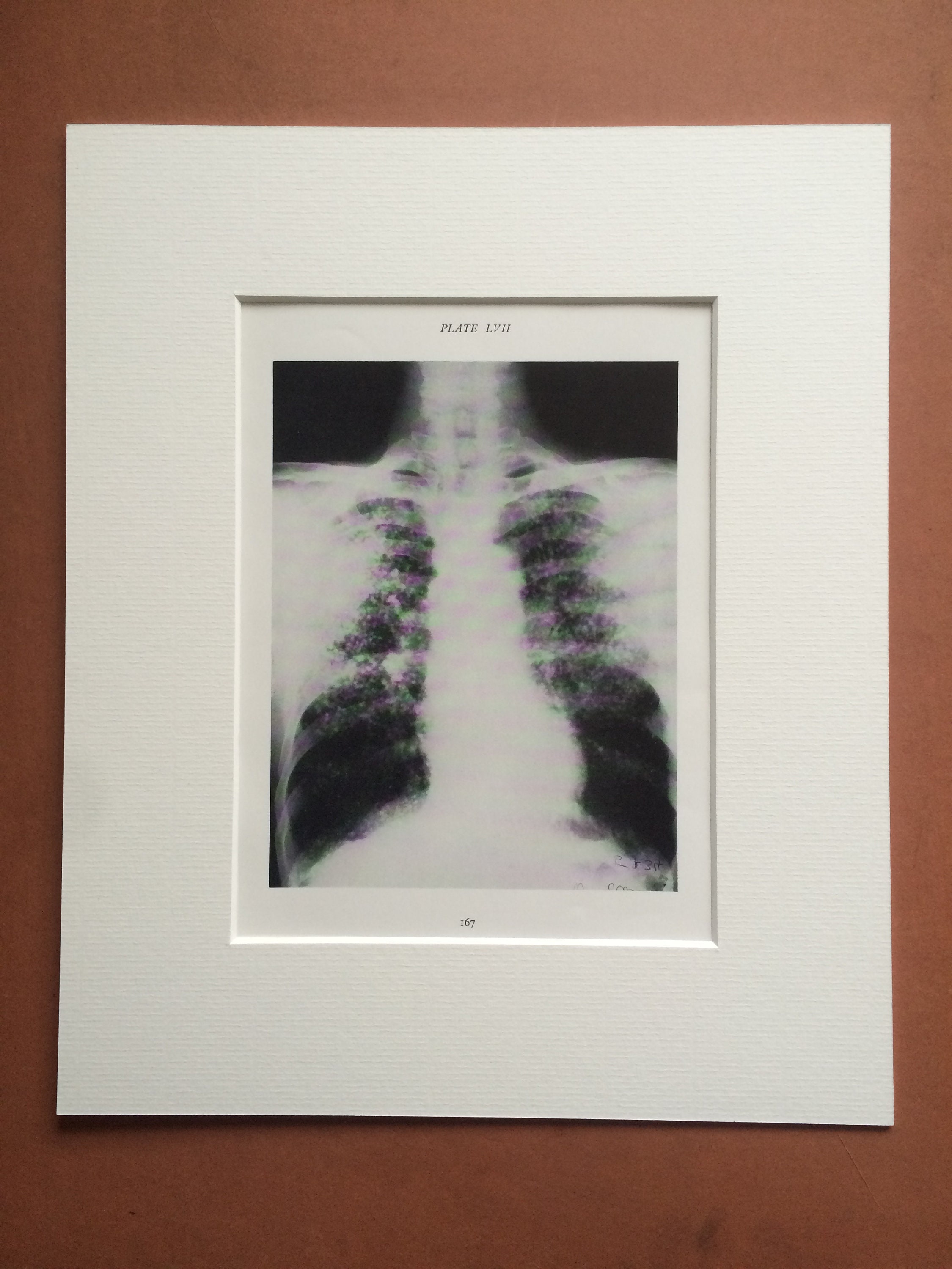1941 chest lung x ray original vintage print mounted and matted