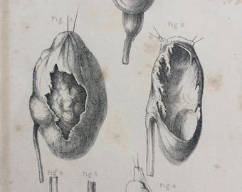 1831 Original Antique Anatomical Print by W. Money - Morbid Anatomy  - Pathology - Gift for Doctor or Medical Student - Oddity - Curiosity