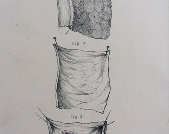 1831 Original Antique Anatomical Print by W. Money - Morbid Anatomy  - Pathology - Gift for Doctor or Medical Student - Oddity - Curiosity