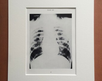 1941 Chest & Lung X-Ray Original Vintage Print - Mounted and Matted - Silicosis - Radiology - Medical Decor - Science - Available Framed