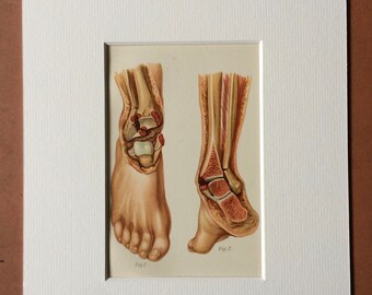 1902 Original Antique Anatomical Print - Available Mounted and Matted - Fracture - Dislocation - Medical Decor - Anatomy - Available Framed