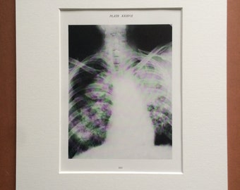 1941 Chest & Lung X-Ray Original Vintage Print - Mounted and Matted - Silicosis - Radiology - Medical Decor - Science - Available Framed