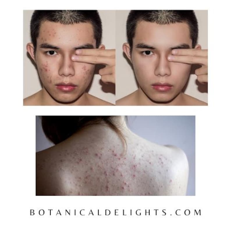 Tea Tree & Salicylic Acid Gel, Clear Skin Herbal Moisturizer, Deep pore cleansing, Blemish-Prone imagem 3