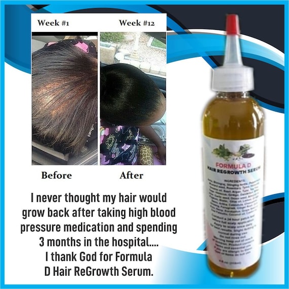 Extra Strength Formula D Hair Growth Oil With Amla Coconut Oil - Etsy