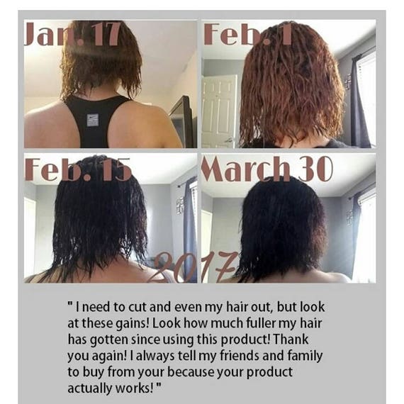Formula D Hair Regrowth Serum Good for CCCA - Etsy Formula D Hair Regrowth Serum Good for CCCA - Etsy