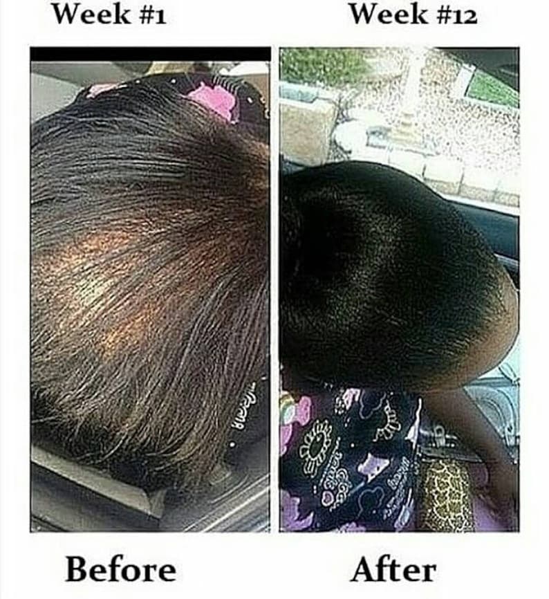KIT:Formula D Hair Re-Growth Oil Serum & Shampoo DHT ...
