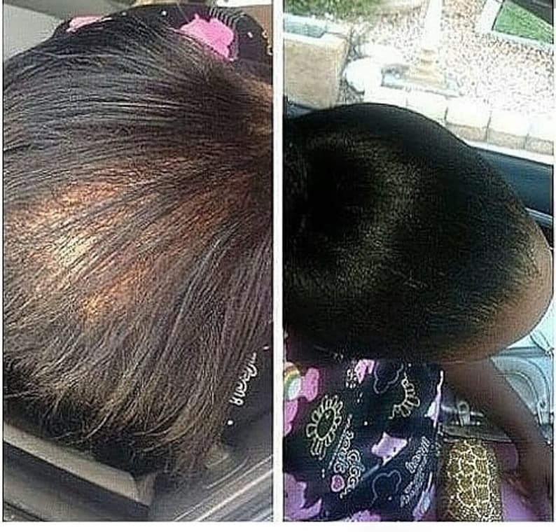 Pu&ograve; includere: Fotografie prima e dopo che mostrano i risultati di un trattamento per la crescita dei capelli. La prima foto mostra una persona con i capelli radi sulla parte superiore della testa. La seconda foto mostra la stessa persona con i capelli pi&ugrave; folti e spessi.
