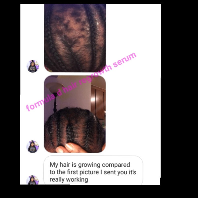 Pu&ograve; includere: Due foto che mostrano il progresso della crescita dei capelli. La prima foto mostra un cuoio capelluto con una crescita di capelli rada. La seconda foto mostra lo stesso cuoio capelluto con una crescita di capelli pi&ugrave; abbondante. Il testo dell'immagine dice "formula hair regrowth serum. My hair is growing compared to the first picture I sent you it's really working."