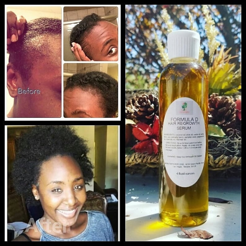 Pu&ograve; includere: Fotografie prima e dopo che mostrano la ricrescita dei capelli usando una bottiglia di vetro trasparente etichettata "Formula D Hair Regrowth Serum". La bottiglia contiene un liquido giallo e si trova su un cesto di vimini marrone con pigne e bacche rosse.