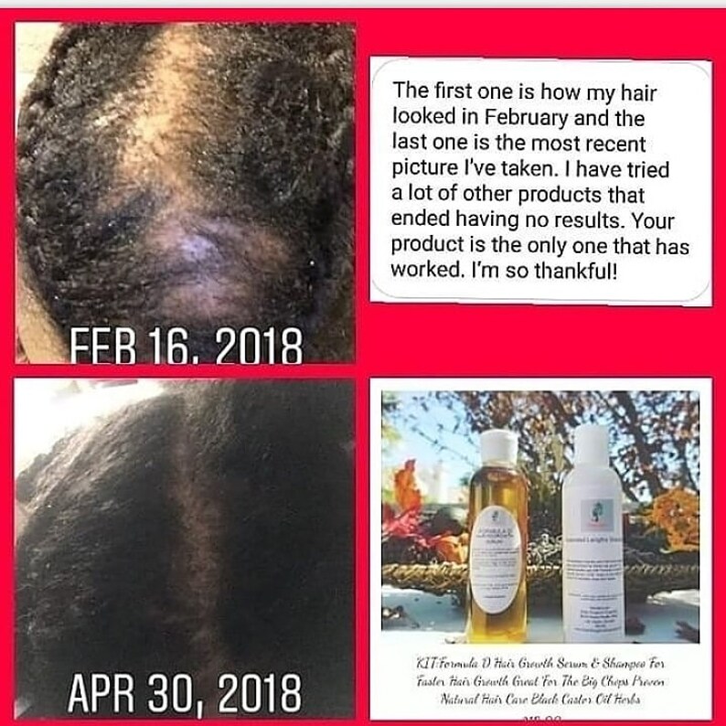 Pu&ograve; includere: Foto prima e dopo che mostrano la crescita dei capelli. La prima foto &egrave; datata 16 febbraio 2018 e mostra una persona con i capelli radi. La seconda foto &egrave; datata 30 aprile 2018 e mostra la stessa persona con i capelli pi&ugrave; folti. Il testo nell'immagine recita: "La prima foto mostra come erano i miei capelli a febbraio e l'ultima foto &egrave; la pi&ugrave; recente che ho scattato. Ho provato molti altri prodotti che non hanno dato alcun risultato. Il tuo prodotto &egrave; l'unico che ha funzionato. Sono cos&igrave; grata!" Nell'immagine sono mostrate due bottiglie di siero e shampoo per la crescita dei capelli.