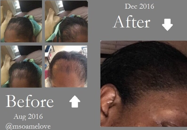 Formula D Hair ReGrowth Serum Good For CCCA | Etsy