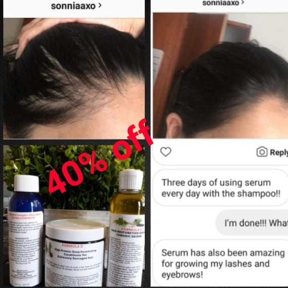 Formula D Extra Strength 3 Piece Kit Hair Restoration For Catastrophic Hair Loss Dandruff Severe Itching Patchy Bald Spots Receding Hairline