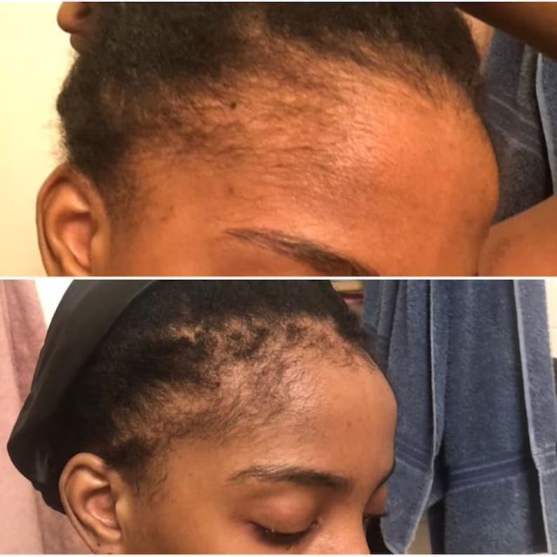 May include: Before and after photos showing hair growth along the hairline. The top photo shows a person with a receding hairline. The bottom photo shows the same person with a fuller hairline.