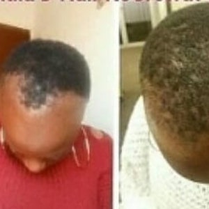 Pu&ograve; includere: Fotografie prima e dopo che mostrano il cuoio capelluto di una persona con perdita di capelli e poi con la ricrescita dei capelli.