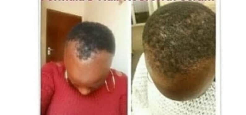Pu&ograve; includere: Fotografie prima e dopo che mostrano il cuoio capelluto di una persona con perdita di capelli e poi con la ricrescita dei capelli.