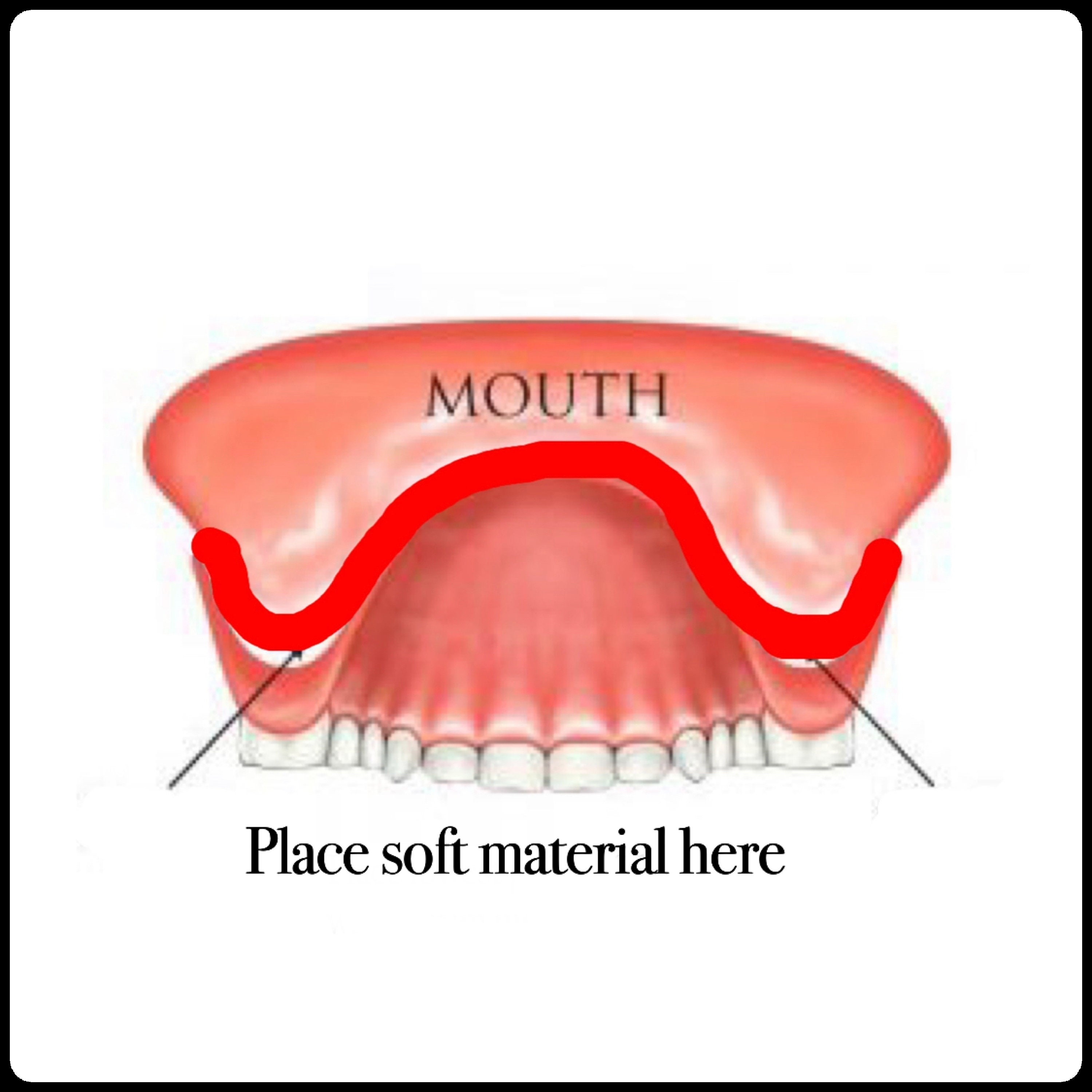 DIY Reline Denture Pink Gum Material Denture Teeth Gum Etsy