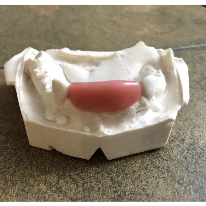 Missing Tooth Kit Front Flipper Denture Resin Denture Teeth Etsy