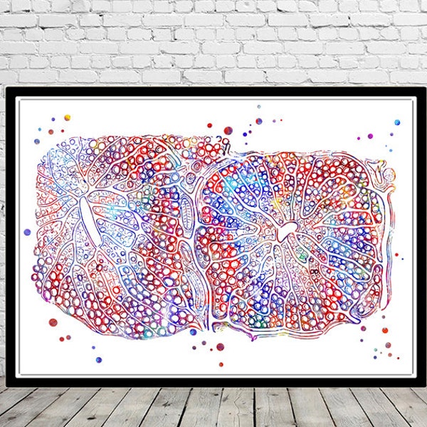 Fatty infiltration of the liver wall art watercolor print medical art, fatty infiltration liver art clinic office decor personalized gifts