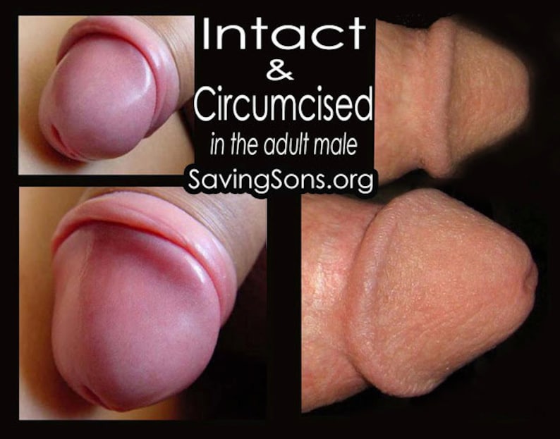 Intact vs Circumcised Adult Info Postcards