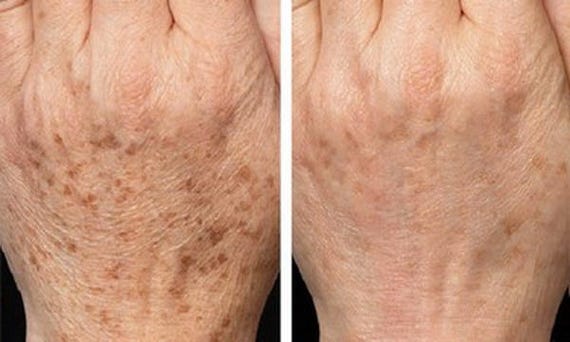 Age Spot Corrector Age Spot Cream Age Spot Lotion Dark Etsy Age Spot Corrector Age Spot Cream Age Spot Lotion Dark Etsy