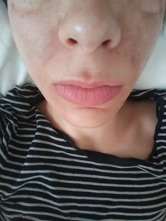 Vegan Lactic Acid Acne & Scars at Home Peel 50 Bestseller Etsy