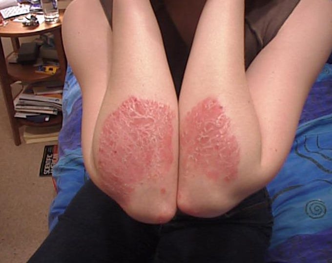 Scaly Skin Salve