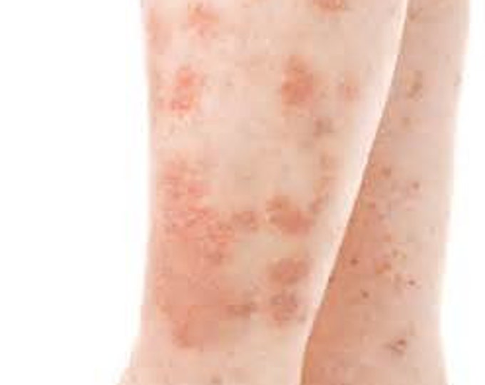 Scaly Skin Salve