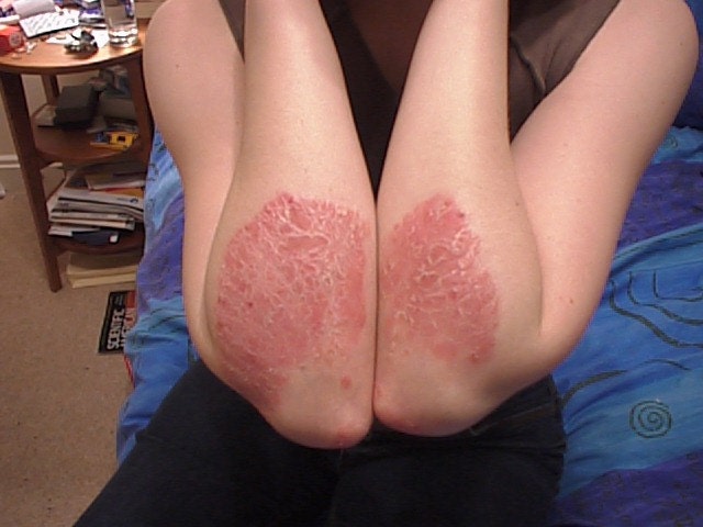 Psoriasis and Eczema Salve