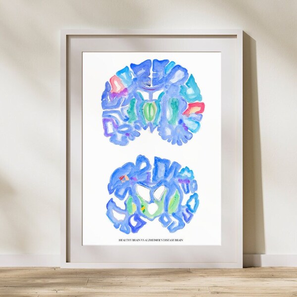 Normal vs Alzheimer Brain Gross Pathology Abstract Watercolor Anatomy Painting for Neurology and Neuroscience Offices