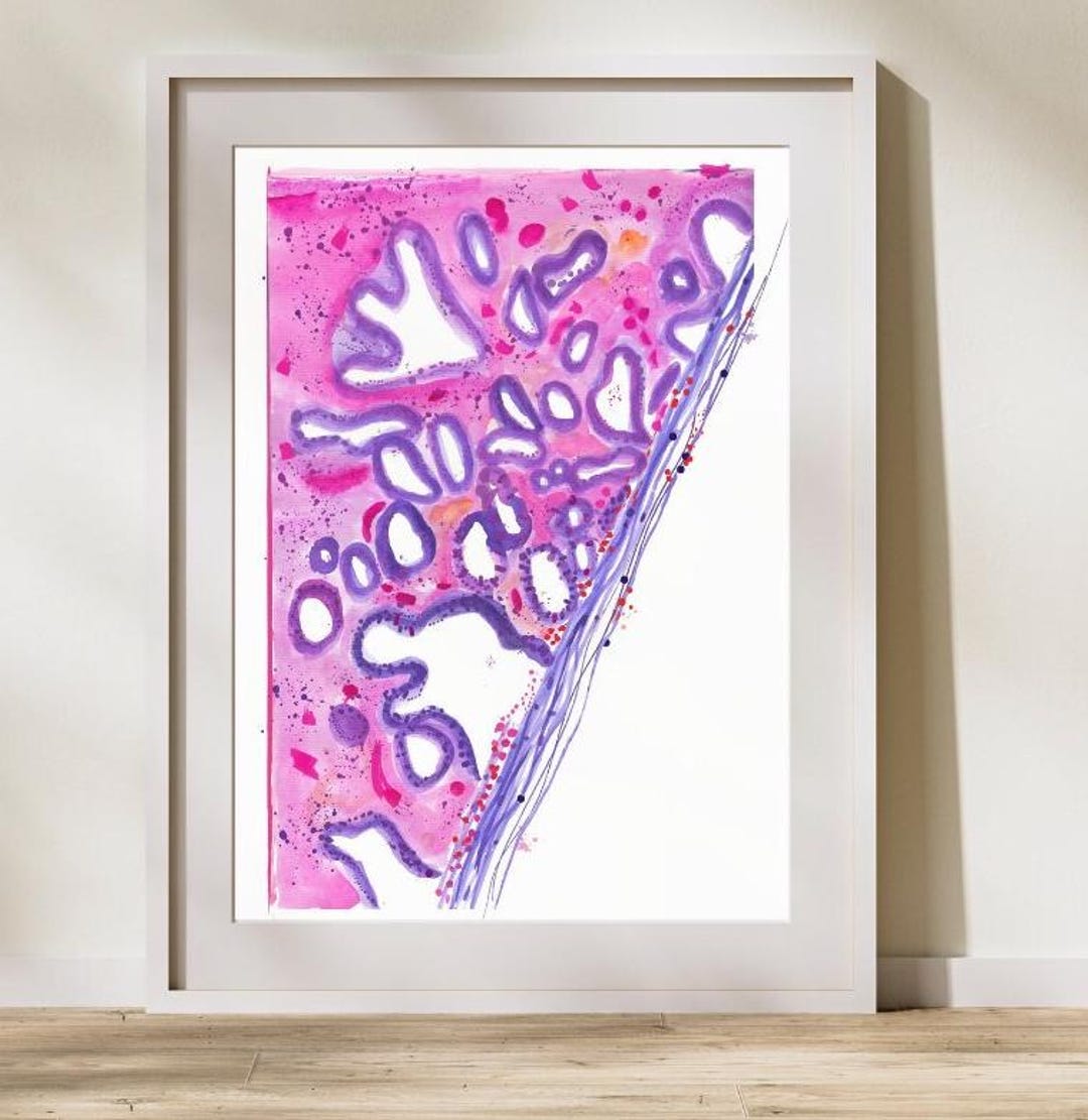 Cervical Cancer HPV Associated Adenocarcinoma, Gynecologic Pathology ...