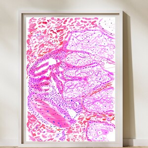 Leprosy, Hansen Disease, Mycobacterium leprae, Microbiology Art, Pathology Art, Infectology, Histopathology Art, Infectious Disease