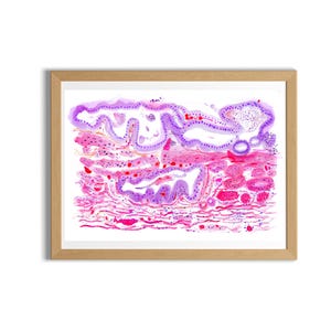Cholecyst Pathology Art- Chronic Cholecystitis  Gallbladder Pathology, Pathologist Doctor Resident and Assistant Gift, Histology Tech Gift