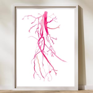 Angiogram, Vascular Surgery Art, Radiology Decor,  Femoral Spf Artery Occlusion, Interventional Radiology Gifts, Radiology Tech Gift