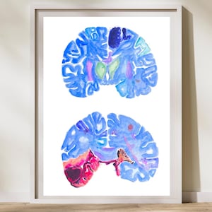 Stroke, Neurology Art, Neurologist Gift, Neurosurgery, Pathology Art, Stroke Poster, Neurology Print, Brain Painting, Pathology Assistant