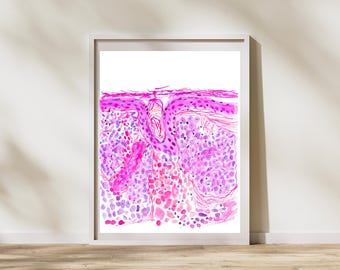 Basalzellkrebs - Pathologie Aquarell Kunstdruck, Dermatologie Geschenke, Geschenk für Pathologen