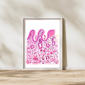 Stomach Signet Ring Cell Carcinoma, Pathology Art, Histopathology Print, Gift for Pathology Doctor and Assistant, Endoscopy Doctor Gift