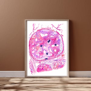 Cancer du sein - art de la pathologie - cadeau pathologie du sein, art histologie, cadeau chirurgien mammaire