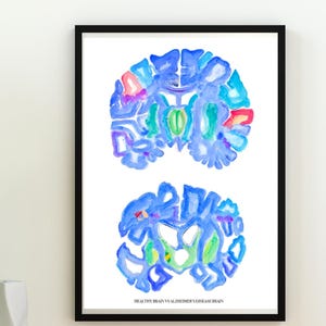 Alzheimer&#39;s, Neurology Art, Neurology Brain Art, Gift for Neurologists and Neuroscience Lovers, Neuro Decor for Clinic and Office