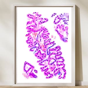 Urothelial Carcinoma, Pathology Art, Pathology Gifts, Histology Art, Urology Art, Urologist Gift, Pathology Assistant, Laboratory Wall Decor
