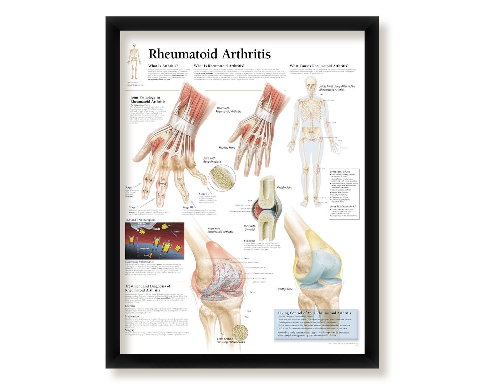 Rheumatoid Arthritis Framed Medical Educational Informational Etsy