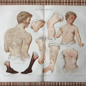 Antique Medical Print, Original 1890s Lithograph, True Antique Print, Encyclopedia Print, Diseases Print, Chromolithograph