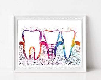 Implant teeth diagram, medical poster, dental office, dental art, dental implant, teeth, dentist gift