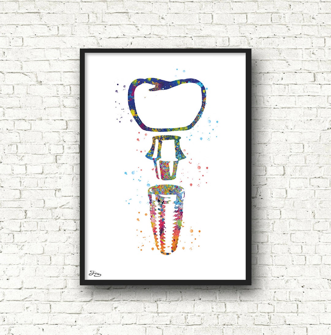 Implant Poster, Dentist Gift, Tooth Art, Dental Office Decoration