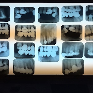 May include: A set of 18 dental x-rays showing the teeth and jaw of a patient.