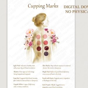Cupping Therapy Art Print for Holistic Healing Rooms | Traditional Cupping Poster for Massage & Wellness Spaces | Printable Wall Art image 1