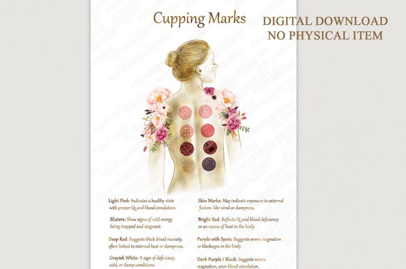Cupping Therapy Art Print for Holistic Healing Rooms | Traditional Cupping Poster for Massage & Wellness Spaces | Printable Wall Art