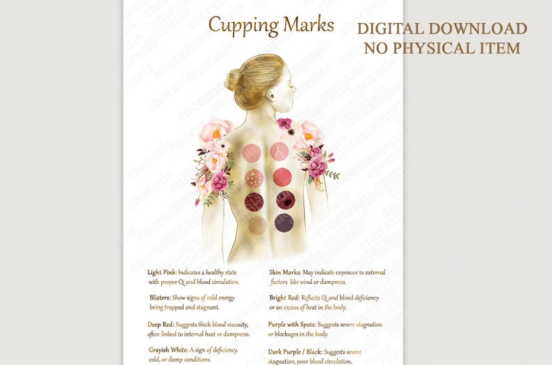 Cupping Therapy Art Print for Holistic Healing Rooms | Traditional Cupping Poster for Massage & Wellness Spaces | Printable Wall Art image 1